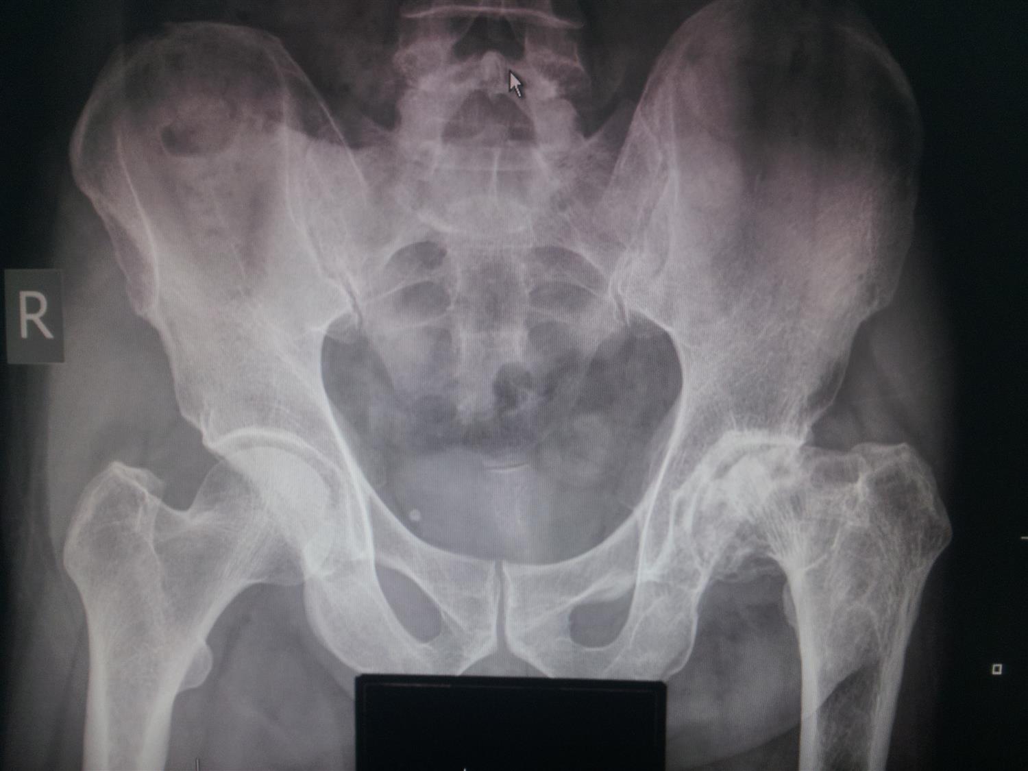 Osteonecrosis Of Hip
